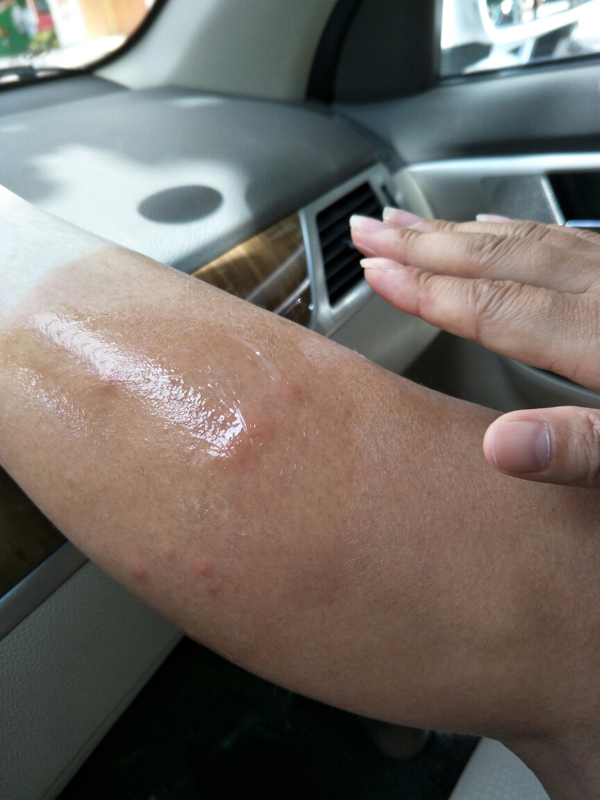 回复游记:三亚被海边的小白色蚊子咬了